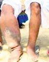 Odisha gears up for MDA to eliminate lymphatic filariasis18