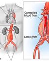 Ground-breaking Medical Procedure EVAR Performed At GMC Sgr27