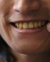 Study Looking At Teeth Provides Evidence Of Lasting Damage Due To Smoking5