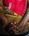 Research Suggests Mental Health Support For Burn Survivors In Health Facilities To Deal With Stigma0