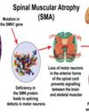 Boy gets Rs 17cr life-saving gene therapy for rare SMA type 1