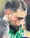 Keeper sustains bad facial injury