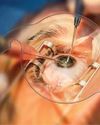 Overberg patients receive life-changing cataract surgery7