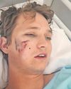 Survivor of hyena attack plans to return to Cape Vidal nature reserve10