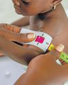 Spotting severe malnutrition in children: essential tips for parents47