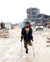 Gaza’s amputees face life in war zone with little treatment, less hope Gaza’s amputees face life in war zone with little treatment, less hope
