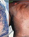 9 Suffer Serious Skin Reactions After Taking Energy-Boosting Medicines 9 Suffer Serious Skin Reactions After Taking Energy-Boosting Medicines