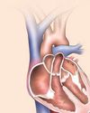 New, less invasive procedure to solve blockages in mechanical heart pumps30