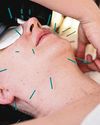 In the age of #notox, can cosmetic acupuncture be the new Botox?63