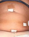Irish bride-to-be also needed gallbladder removed30