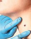 Jab slashes skin cancer returning by nearly half Jab slashes skin cancer returning by nearly half36