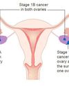 Potential therapeutic target identified for ovarian cancer Potential therapeutic target identified for ovarian cancer32
