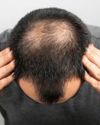 Kanpur engineers die after botched hair transplant: What questions should you ask your dermatologist? Indian Chronicle