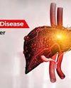Fatty liver to cirrhosis: Why can't you see the silent damage? Indian Chronicle