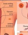 All you need to know about: aneurysms Indian Chronicle