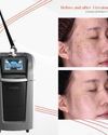 Award-Winning Innovation: PicoSure® Pro Sets New Benchmark in Picosecond Laser Technology24