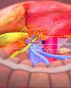 THE RISKS OF UNDIAGNOSED GALL BLADDER STONES: DOCTORS CALL FOR AWARENESS, TIMELY TREATMENT13