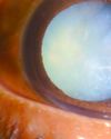 UNDERSTANDING CATARACTS AND THE SURGERY TO TREAT THEM13