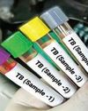 Made-in-India TB diagnostic tests validated by ICMR; offer cheaper, faster detection6