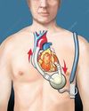India to develop artificial heart to help transplant patients20