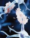Early-onset Alzheimer’s: New drug shows promise in slowing the disease18