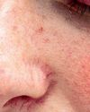 Psoriasis y enfermedades de la piel en general