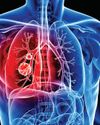 Study shows tumour DNA in blood can predict lung cancer outcome