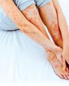 Study Shows Why Psoriasis Patients May Be at Risk of Obesity, Fatty Liver Disease47
