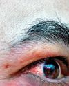 Mucormycosis survivors battle lingering scars39