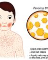 Parvovirus B19 can cause serious encephalitis: Study2