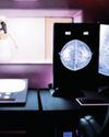 AI-supported mammography more effective than standard47