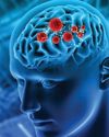 Busting Common Myths About Brain Tumours The Northlines