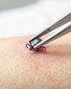 Lyme Disease is still rare but perhaps less rare than it was Lyme Disease is still rare but perhaps less rare than it was11