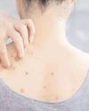 Bacne, or back acne, can be embarrassing. How to deal with it?9