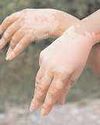 Vitiligo: Doctors debunk some common myths on leukoderma or white leprosy25