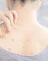Bacne, or back acne, can be embarrassing. How to deal with it? Bacne, or back acne, can be embarrassing. How to deal with it?40