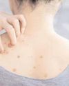 Bacne, or back acne, can be embarrassing. How to deal with it? Bacne, or back acne, can be embarrassing. How to deal with it?41