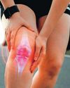 NON-SURGICAL OPTION TO EASE KNEE ARTHRITIS