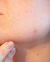 BEATING ACNE NATURALLY: AYURVEDA HERBS, HOMEOPATHY TIPS AND 6 LIFESTYLE CHANGES TO DETOX YOUR SKIN18