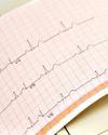 What is atrial fibrillation and how is it treated?35