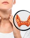 Thyroid Nodules