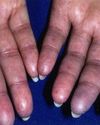 Scleroderma