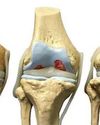 Why Do People Need Knee Replacement?