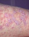 Lichen Planus