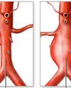 Bulging Aorta: What You Need to Know About Aortic Aneurysms