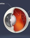 Retinal Detachment A Silent Threat to Vision