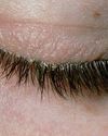 What Triggers Blepharitis and How Can You Prevent It?20