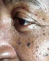 Why Seborrheic Keratosis Appears and How to Manage It Health Vision
