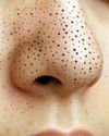 How to Get Rid of BLACKHEADS Naturally and Safely1