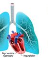 Pulmonary Hypertension The Silent Pressure on Your Heart and Lungs Pulmonary Hypertension The Silent Pressure on Your Heart and Lungs15